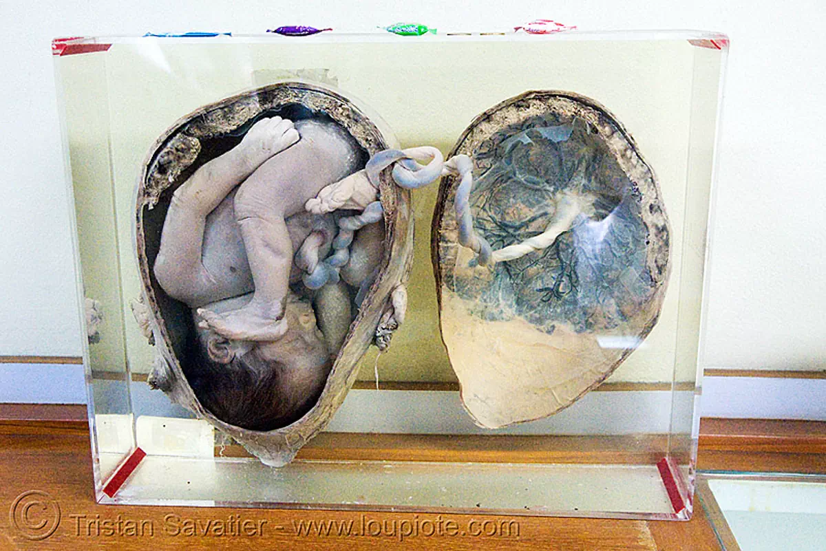 dead fetus in womb, preserved, ศพเด็ก, forensic medicine museum